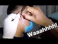 HUGE Earwax Stuck in Man&#39;s Ear Removed!