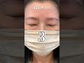 目周り同時にすると急激に変わってしまうかと思われますが、実は意外とナチュラルに変化できます👀#眉下切開 #眉下リフト #切開ハムラ