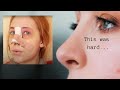 The truth about getting a nose job surgery | My Surgery Story