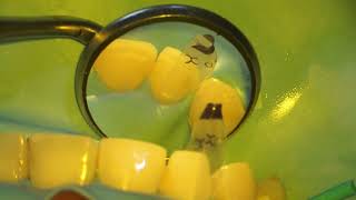 Bioclear TSS Matrix to Correct a Lateral Incisor