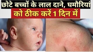 गर्मियों में बच्चों को होने वाले लाल दाने का घरेलु इलाज l Heat rashes treatment for baby