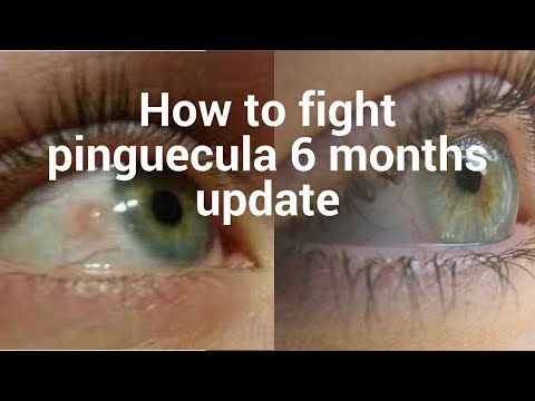 How to fight pinguecula update for 6 months