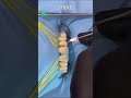 Orthodontic treatment with composite resin restoration dentist shorts
