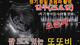 태아 12주 초음파 영상(25.6.12.)