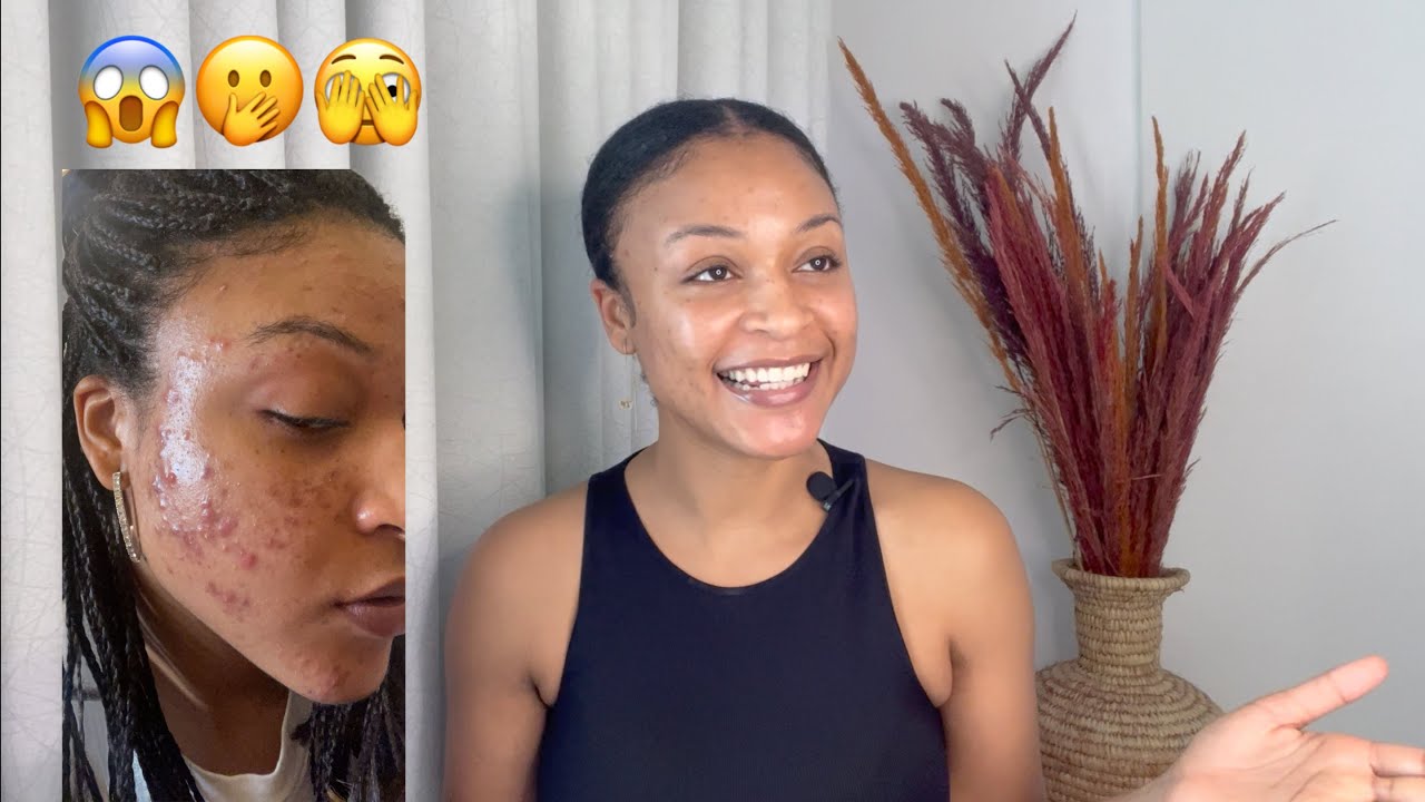 How I Finally Cleared My Acne Youtube