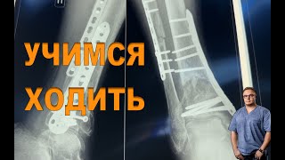 УЧИМСЯ ХОДИТЬ ЧЕРЕЗ 3 МЕСЯЦА ПОСЛЕ ОПЕРАЦИИ | Перелом Голени