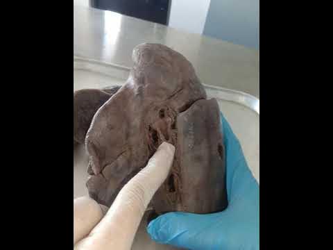 Left Lung Impressions l Anatomy l Cadaver study - YouTube