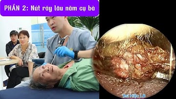 PHẦN 2: Nút ráy lâu năm gây tổn thương ống tai cụ bà cao tuổi 耳かき - ASMR耳掃除 | Bác sĩ Hiệu Long Biên