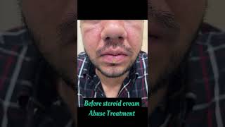 Steroid cream abuse treatment | PARISA skin clinic | Dermatologist in Punjab | Dr Ashima Goel MD