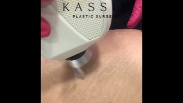 CO2 Laser for Stretch Marks by Dr. Kassir