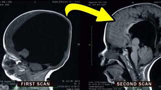 Boy Born With 2% Brain Grows The Rest On His Own