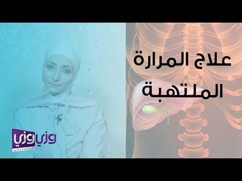 فيديو: أعراض وعلاجات التهاب المرارة في المنزل