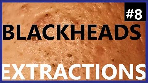 BLACKHEADS EXTRACTIONS on Happy :)- #8