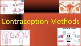 Contraception Methods , TOG article and FSRH guideline