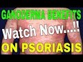 Dxn ganoderma benefits on psoriasis by dr r buddha dev md dermatology