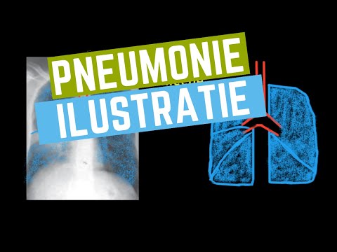 Video: Pneumonia (Intersticiale) Te Macet
