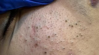 Skincare | Blackhead and Pimple Removal | Deep Cleansing Techniques
