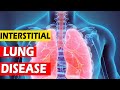 Interstitial Lung Disease pulomonlogy | DR Abdul Saleem | Health And Beauty