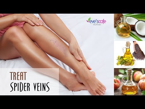 Video: Treatment Of Spider Veins With Folk Remedies