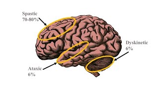 ما هي أنواع الشلل الدماغي ( Cerebral Palsy Types )