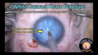 CataractCoach 1220: intumescent white cataract phaco puncture