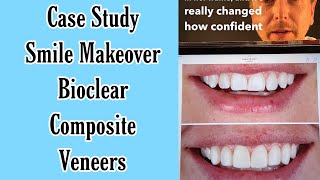 Bioclear Composite Veneers Smile Makeover