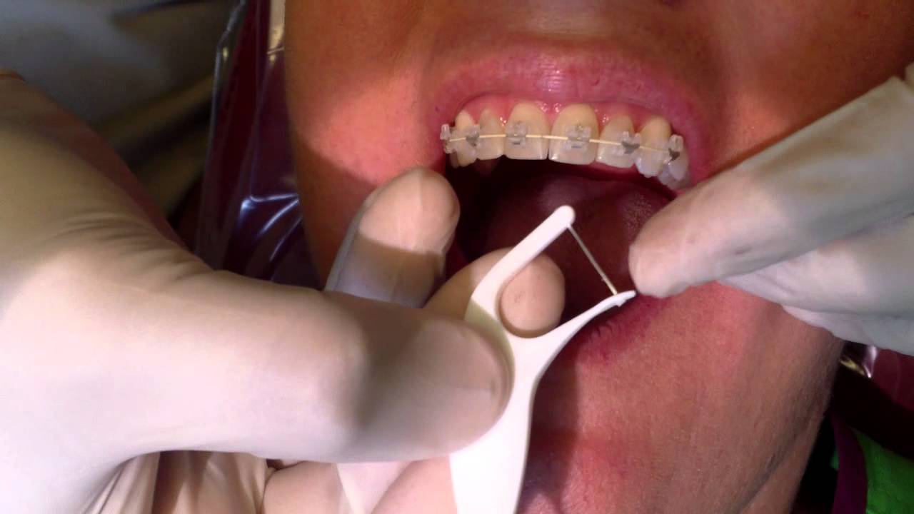 Orthodontic Flossers