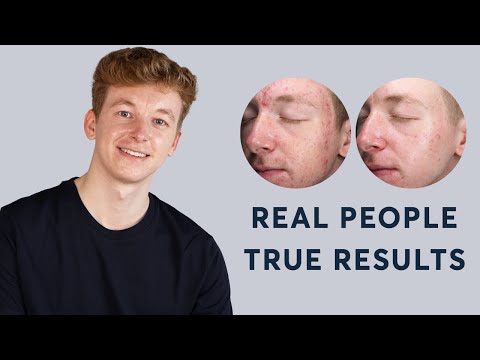 Active Acne Treatment | Real People, True Results 2023
