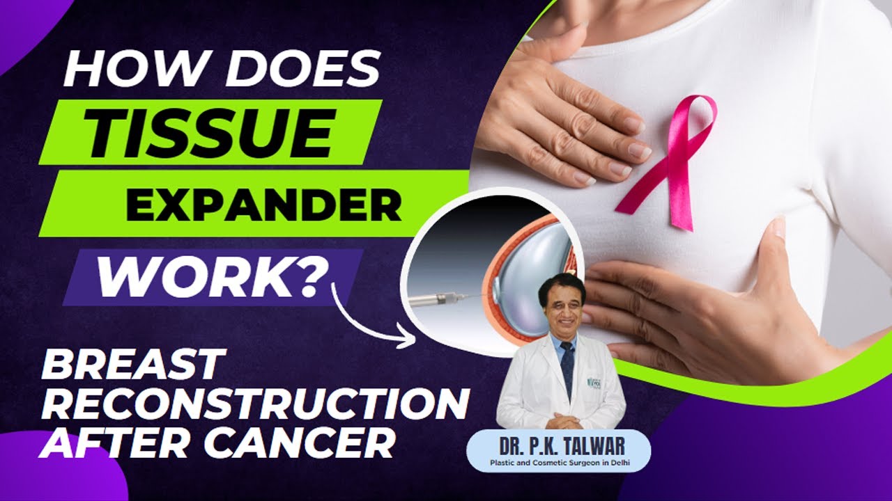 How Does Tissue Expander Work? Breast Reconstruction After Cancer | Dr. PK Talwar