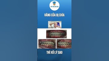 Cách xử lý răng cửa bị chìa trong chỉnh nha! #hocchinhnha #chinhnha #bedaycung