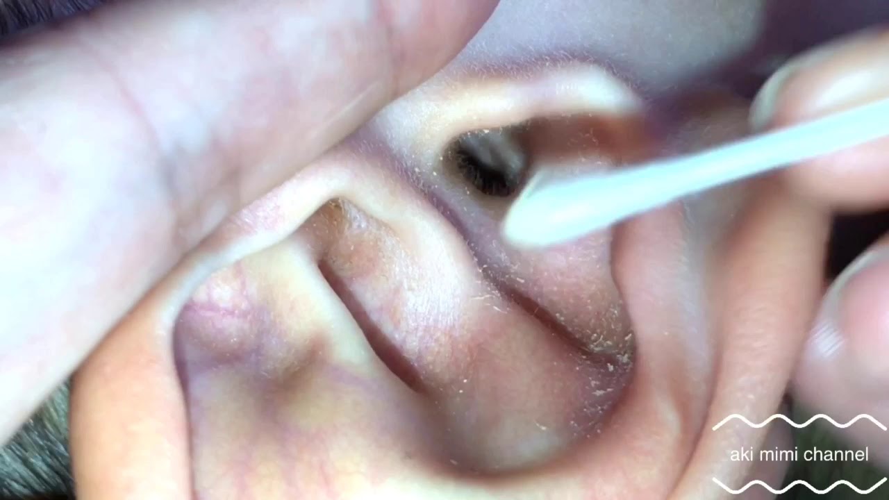 耳掃除 黄色い耳垢大量の飴耳さん 前編 Youtube
