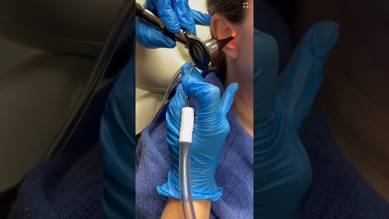 Ear Wax Removal Using Suction By An ENT