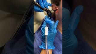 Ear wax removal using suction by an ENT