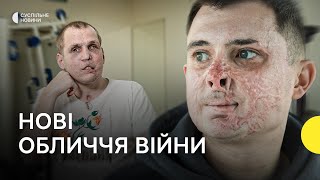 «Це все ще я» — військові, обличчя яких назавжди змінила війна