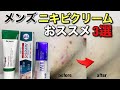 ニキビが治らないメンズへおススメのニキビクリームを【3選】紹介！