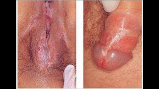 Kencing sakit karena luka lecet dan ruam merah di kelamin || sipilis