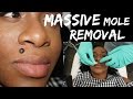Massive Mole Removal| My Radiosurgery Experience with LaserTouchAesthetics 2017