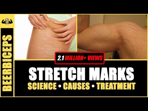 GOODBYE FOREVER - Stretch Marks | Stretch Marks Science, Causes & Treatment | BeerBiceps