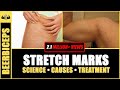 GOODBYE FOREVER, Stretch Mark Trouble | Stretch Marks science, causes & treatment | BeerBiceps