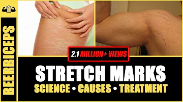 Are stretch marks a bad thing?