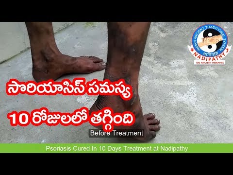 psoriasis-cured-in-10-days-treatment-at-nadipathy