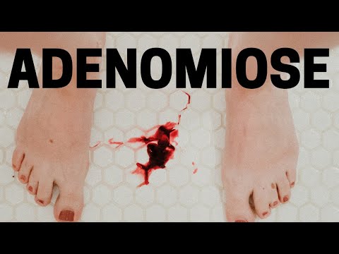 ADENOMIOSE UTERINA – SINTOMAS E TRATAMENTO