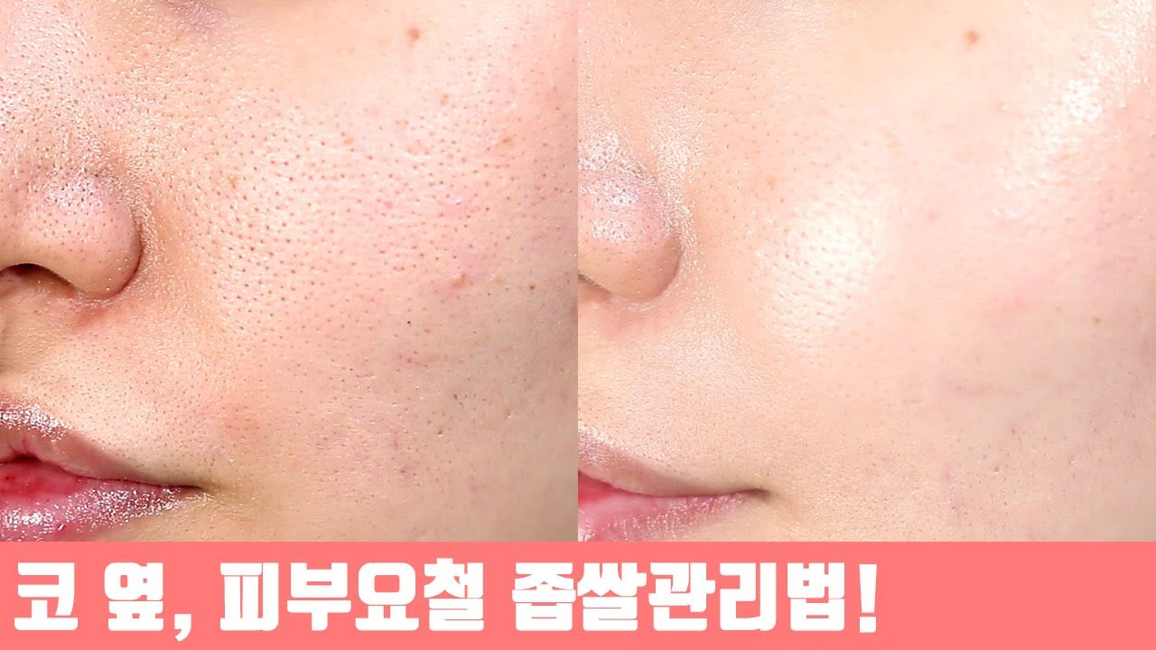 피부과 시술 없이 집에서 오돌토돌 요철, 각질케어하는 법💖 닥터에스떼Rx 리얼 고트밀크필로 물광피부로 [헮TV] - YouTube