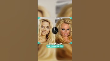 Памела Андерсон: Эволюция внешности до и после пластики #globalmedik #пластическаяоперация