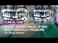 Digital guided sinus lifting with hydraulic pressure part 1