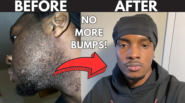 HOW TO PREVENT & GET RID OF RAZOR BUMPS (No Bullsh*t Guide)