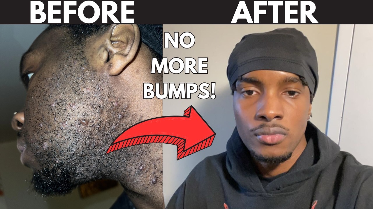 HOW TO GET RID OF RAZOR BUMPS (No Bullsh*t Guide) - YouTube