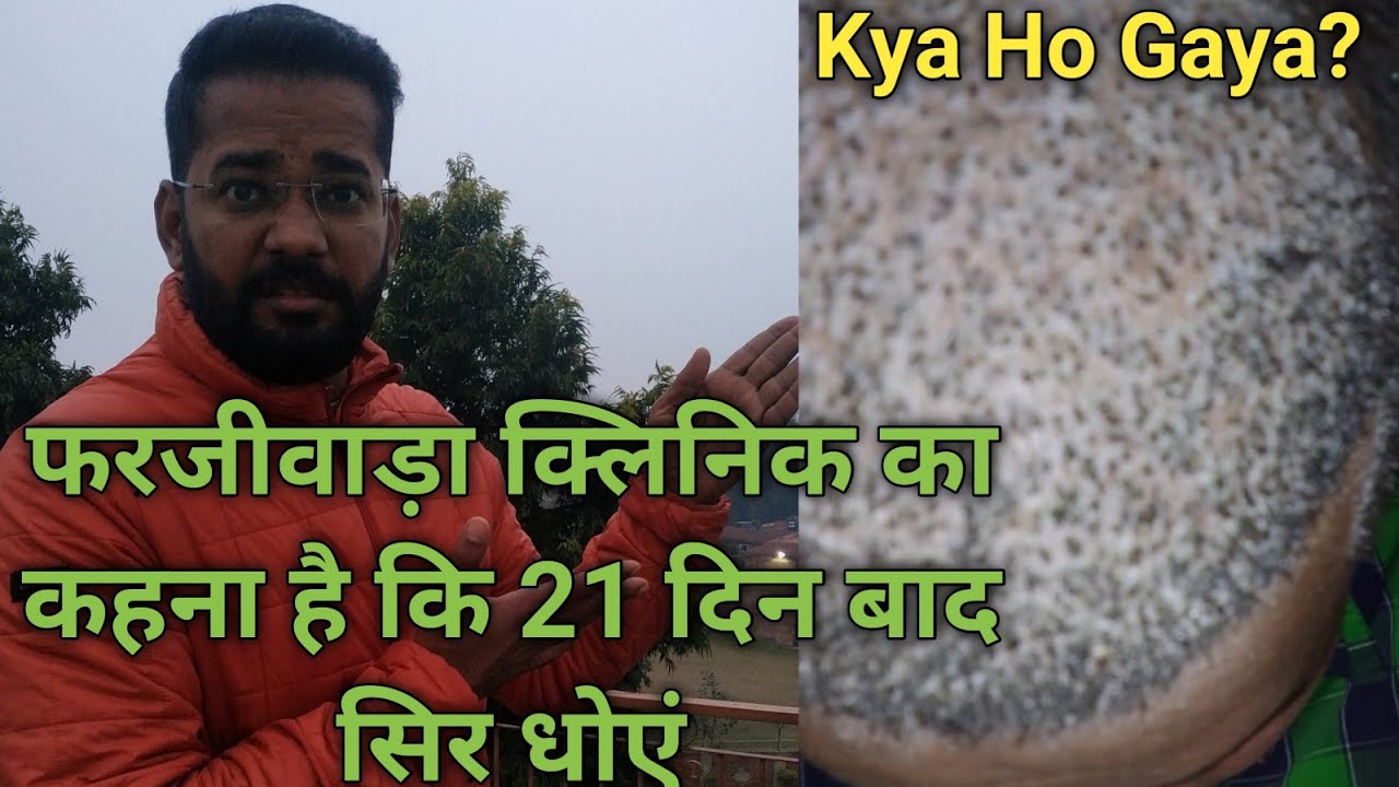 When to Wash Head After Hair Transplant? || बाल धोने का सही समय जानें