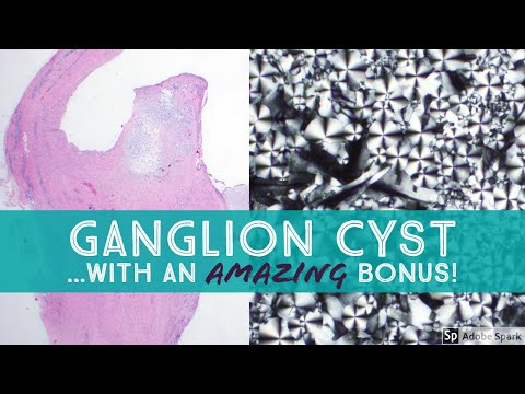 Video: Ganglion Cyst-hjemmebehandling