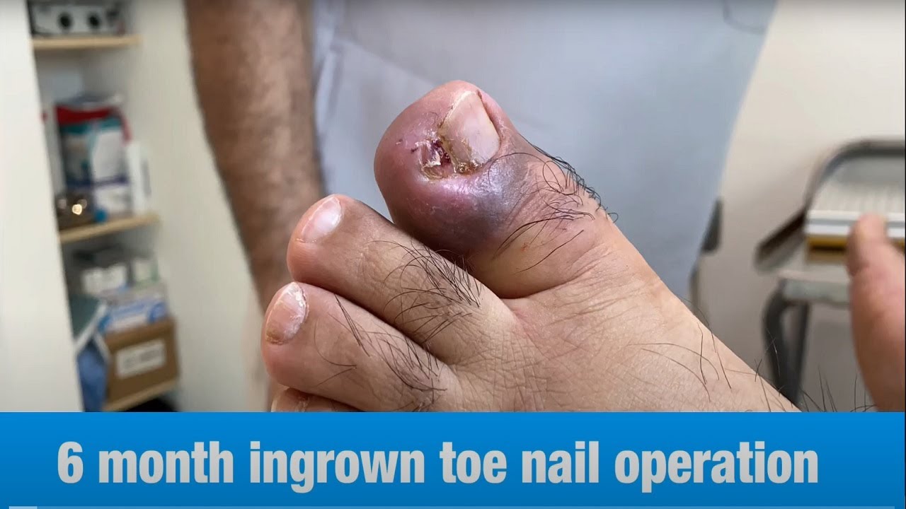 Your Guide To Permanent Toenail Removal